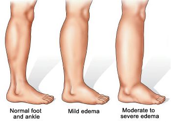 swollen ankle